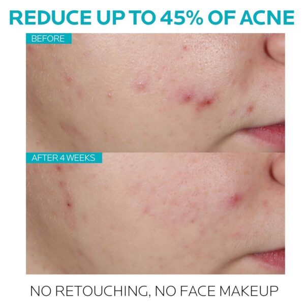 La Roche-Posay Effaclar Salicylic Acid Treatment to Minimize Pores, Clear Acne Blemishes and Post Acne Marks - Image 3